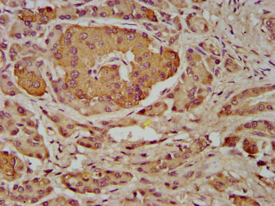 INPP5B Antibody - Immunohistochemistry image at a dilution of 1:400 and staining in paraffin-embedded human pancreatic tissue performed on a Leica BondTM system. After dewaxing and hydration, antigen retrieval was mediated by high pressure in a citrate buffer (pH 6.0) . Section was blocked with 10% normal goat serum 30min at RT. Then primary antibody (1% BSA) was incubated at 4 °C overnight. The primary is detected by a biotinylated secondary antibody and visualized using an HRP conjugated SP system.