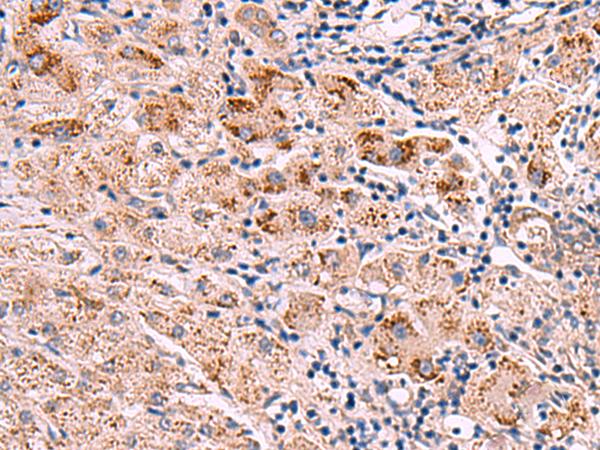 INPP5B Antibody - Immunohistochemistry of paraffin-embedded Human liver cancer tissue  using INPP5B Polyclonal Antibody at dilution of 1:40(×200)