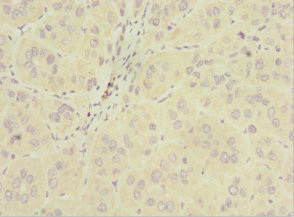 INPP5J / PIB5PA Antibody - Immunohistochemistry of paraffin-embedded human liver cancer at dilution 1:100