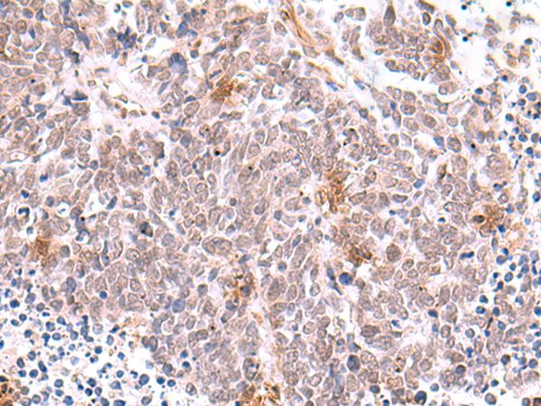 INPP5K / SKIP Antibody - Immunohistochemistry of paraffin-embedded Human lung cancer tissue  using INPP5K Polyclonal Antibody at dilution of 1:90(×200)