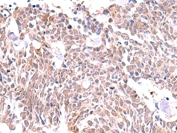 INPP5K / SKIP Antibody - Immunohistochemistry of paraffin-embedded Human lung cancer tissue  using INPP5K Polyclonal Antibody at dilution of 1:85(×200)