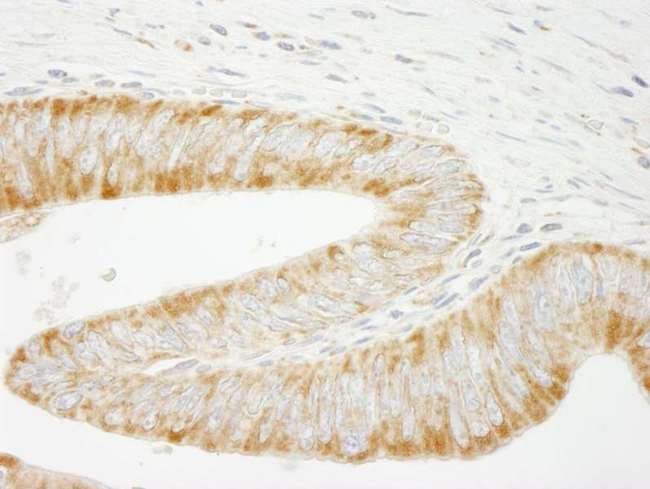 INPPL1 / SHIP2 Antibody - Detection of Human INPPL1/SHIP2 by Immunohistochemistry. Sample: FFPE section of human colon carcinoma. Antibody: Affinity purified rabbit anti-INPPL1/SHIP2 used at a dilution of 1:250. Epitope Retrieval Buffer-High pH (IHC-101J) was substituted for Epitope Retrieval Buffer-Reduced pH.