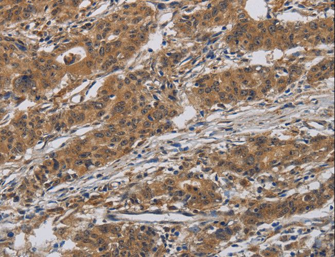 INPPL1 / SHIP2 Antibody - Immunohistochemistry of paraffin-embedded Human gastric cancer using INPPL1 Polyclonal Antibody at dilution of 1:40.