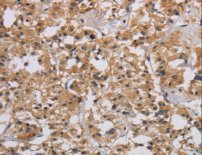INPPL1 / SHIP2 Antibody - Immunohistochemistry of paraffin-embedded Human liver cancer using INPPL1 Polyclonal Antibody at dilution of 1:40.