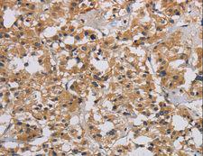 INPPL1 / SHIP2 Antibody - Immunohistochemistry of paraffin-embedded Human liver cancer using INPPL1 Polyclonal Antibody at dilution of 1:40.