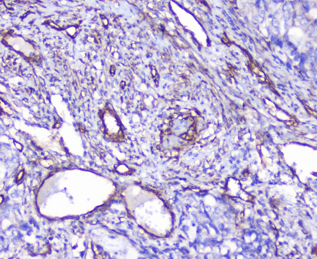 INPPL1 / SHIP2 Antibody - IHC analysis of INPPL1 using anti-INPPL1 antibody. INPPL1 was detected in paraffin-embedded section of human gastric cancer tissue. Heat mediated antigen retrieval was performed in citrate buffer (pH6, epitope retrieval solution) for 20 mins. The tissue section was blocked with 10% goat serum. The tissue section was then incubated with 1µg/ml rabbit anti-INPPL1 Antibody overnight at 4°C. Biotinylated goat anti-rabbit IgG was used as secondary antibody and incubated for 30 minutes at 37°C. The tissue section was developed using Strepavidin-Biotin-Complex (SABC) with DAB as the chromogen.