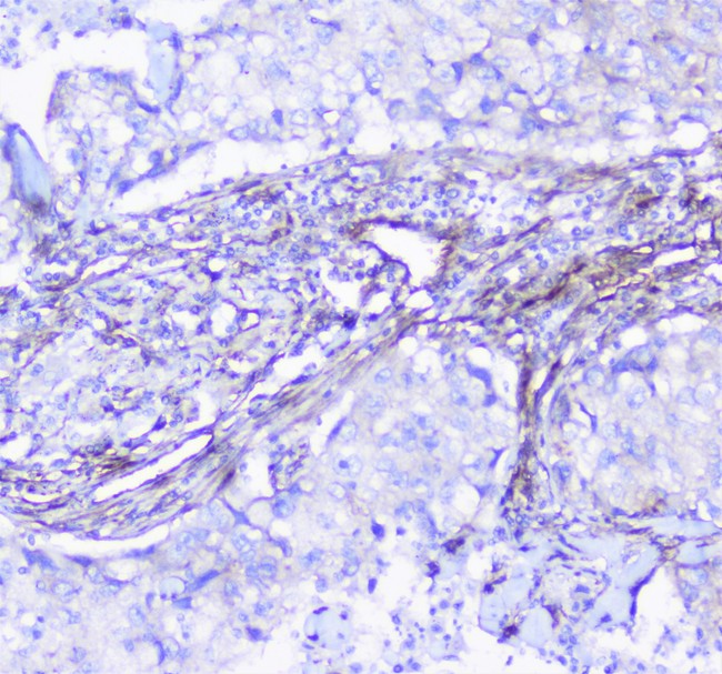 INPPL1 / SHIP2 Antibody - IHC analysis of INPPL1 using anti-INPPL1 antibody. INPPL1 was detected in paraffin-embedded section of human lung cancer tissue. Heat mediated antigen retrieval was performed in citrate buffer (pH6, epitope retrieval solution) for 20 mins. The tissue section was blocked with 10% goat serum. The tissue section was then incubated with 1µg/ml rabbit anti-INPPL1 Antibody overnight at 4°C. Biotinylated goat anti-rabbit IgG was used as secondary antibody and incubated for 30 minutes at 37°C. The tissue section was developed using Strepavidin-Biotin-Complex (SABC) with DAB as the chromogen.