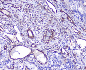 INPPL1 / SHIP2 Antibody - IHC staining of FFPE human stomach cancer with SHIP2 antibody at 1ug/ml. HIER: boil tissue sections in pH6, 10mM citrate buffer, for 10-20 min followed by cooling at RT for 20 min.