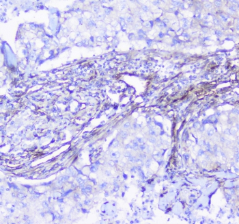 INPPL1 / SHIP2 Antibody - IHC staining of FFPE human lung cancer with SHIP2 antibody at 1ug/ml. HIER: boil tissue sections in pH6, 10mM citrate buffer, for 10-20 min followed by cooling at RT for 20 min.