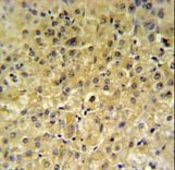 INSC Antibody - INSC Antibody IHC of formalin-fixed and paraffin-embedded hepatocarcinoma followed by peroxidase-conjugated secondary antibody and DAB staining.