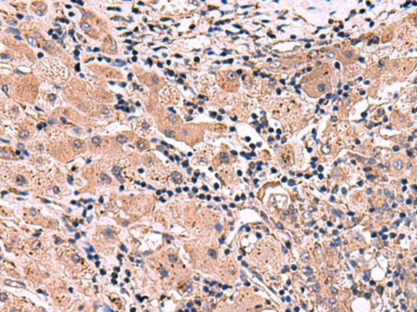 INSC Antibody - Immunohistochemistry of paraffin-embedded Human liver cancer tissue  using INSC Polyclonal Antibody at dilution of 1:65(×200)