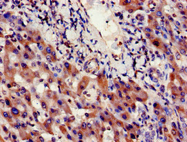 INSIG1 Antibody - Immunohistochemistry image of paraffin-embedded human liver cancer at a dilution of 1:100