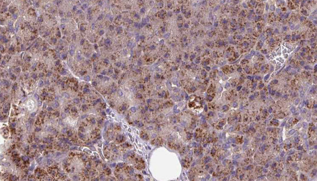 INSIG1 Antibody - 1:100 staining human pancreas carcinoma tissue by IHC-P. The sample was formaldehyde fixed and a heat mediated antigen retrieval step in citrate buffer was performed. The sample was then blocked and incubated with the antibody for 1.5 hours at 22°C. An HRP conjugated goat anti-rabbit antibody was used as the secondary.