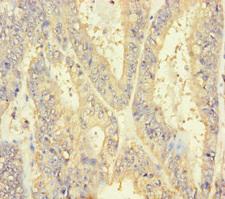 INSL4 Antibody - Immunohistochemistry of paraffin-embedded human endometrial cancer using INSL4 Antibody at dilution of 1:100