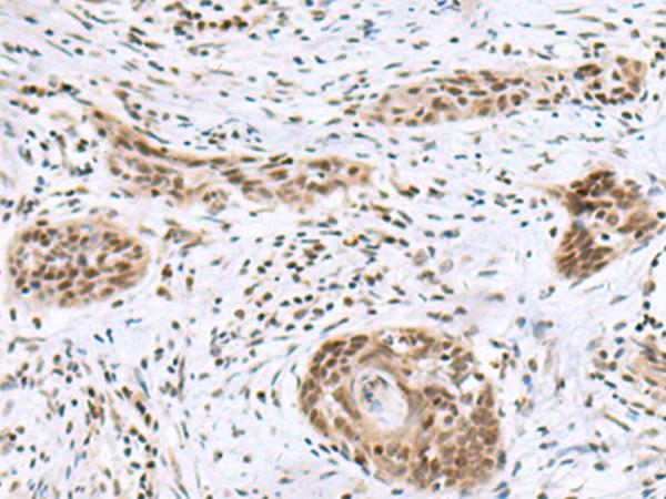 INSM1 Antibody - Immunohistochemistry of paraffin-embedded Human esophagus cancer tissue  using INSM1 Polyclonal Antibody at dilution of 1:50(×200)