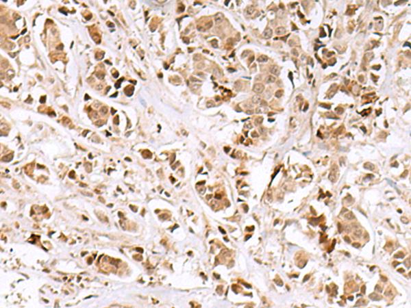 INSM1 Antibody - Immunohistochemistry of paraffin-embedded Human breast cancer tissue  using INSM1 Polyclonal Antibody at dilution of 1:50(×200)