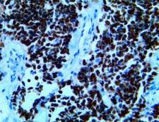 INSM1 Antibody - IHC of INSM1 on an FFPE Neuroendocrine Lung Carcinoma Tissue