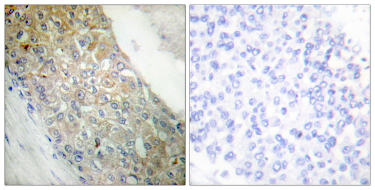 INSR / Insulin Receptor Antibody - Immunohistochemistry analysis of paraffin-embedded human breast carcinoma tissue, using IR Antibody. The picture on the right is blocked with the synthesized peptide.