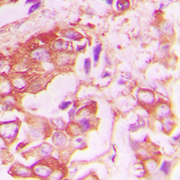 INSR / Insulin Receptor Antibody - Immunohistochemical analysis of Insulin Receptor (pY1355) staining in human lung cancer formalin fixed paraffin embedded tissue section. The section was pre-treated using heat mediated antigen retrieval with sodium citrate buffer (pH 6.0). The section was then incubated with the antibody at room temperature and detected using an HRP conjugated compact polymer system. DAB was used as the chromogen. The section was then counterstained with hematoxylin and mounted with DPX.
