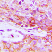 INSR / Insulin Receptor Antibody - Immunohistochemical analysis of Insulin Receptor staining in human breast cancer formalin fixed paraffin embedded tissue section. The section was pre-treated using heat mediated antigen retrieval with sodium citrate buffer (pH 6.0). The section was then incubated with the antibody at room temperature and detected using an HRP conjugated compact polymer system. DAB was used as the chromogen. The section was then counterstained with hematoxylin and mounted with DPX.