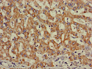 INSR / Insulin Receptor Antibody - Immunohistochemistry of paraffin-embedded human liver cancer at dilution of 1:100