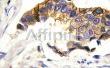 INSR / Insulin Receptor Antibody - 1:100 staining IKB epsilon in human breast carcinoma by IHC using paraffin-embedded tissue