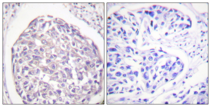 INSR / Insulin Receptor Antibody - Immunohistochemistry analysis of paraffin-embedded human breast carcinoma, using IR (Phospho-Tyr1355) Antibody. The picture on the right is blocked with the phospho peptide.