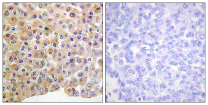 INSR / Insulin Receptor Antibody - Immunohistochemistry analysis of paraffin-embedded human breast carcinoma, using IR (Phospho-Tyr1361) Antibody. The picture on the right is blocked with the phospho peptide.