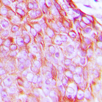 INSR / Insulin Receptor Antibody - Immunohistochemical analysis of Insulin Receptor (pY1361) staining in human breast cancer formalin fixed paraffin embedded tissue section. The section was pre-treated using heat mediated antigen retrieval with sodium citrate buffer (pH 6.0). The section was then incubated with the antibody at room temperature and detected using an HRP conjugated compact polymer system. DAB was used as the chromogen. The section was then counterstained with hematoxylin and mounted with DPX.