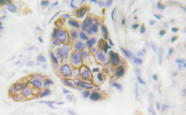 INSR / Insulin Receptor Antibody - 1/100 staining human breast carcinoma tissue by IHC-P. The sample was formaldehyde fixed and a heat mediated antigen retrieval step in citrate buffer was performed. The sample was then blocked and incubated with the antibody for 1.5 hours at 22°C. An HRP conjugated goat anti-rabbit antibody was used as the secondary antibody.