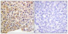 INSR / Insulin Receptor Antibody - P-peptide - + Immunohistochemistry analysis of paraffin-embedded human breast carcinoma tissue using using IR (Phospho-Tyr1361) antibody.