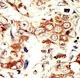 INSRR Antibody - Formalin-fixed and paraffin-embedded human cancer tissue reacted with the primary antibody, which was peroxidase-conjugated to the secondary antibody, followed by AEC staining. This data demonstrates the use of this antibody for immunohistochemistry; clinical relevance has not been evaluated. BC = breast carcinoma; HC = hepatocarcinoma.