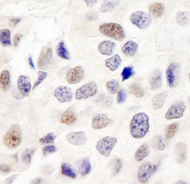 INT7 / INTS7 Antibody - Detection of Human DKFZP434B168 by Immunohistochemistry. Sample: FFPE section of human breast carcinoma. Antibody: Affinity purified rabbit anti-DKFZP434B168 used at a dilution of 1:1000 (1 ug/ml). Detection: DAB.