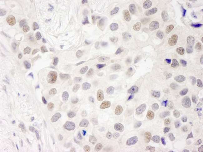 INT7 / INTS7 Antibody - Detection of Human INT7 by Immunohistochemistry. Sample: FFPE section of human breast carcinoma Antibody: Affinity purified rabbit anti-INT7 used at a dilution of 1:250.