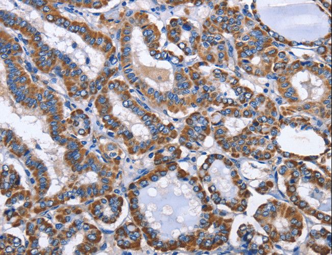 INTS10 Antibody - Immunohistochemistry of paraffin-embedded Human thyroid cancer using INTS10 Polyclonal Antibody at dilution of 1:50.