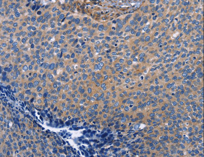 INTS10 Antibody - Immunohistochemistry of paraffin-embedded Human cervical cancer using INTS10 Polyclonal Antibody at dilution of 1:50.