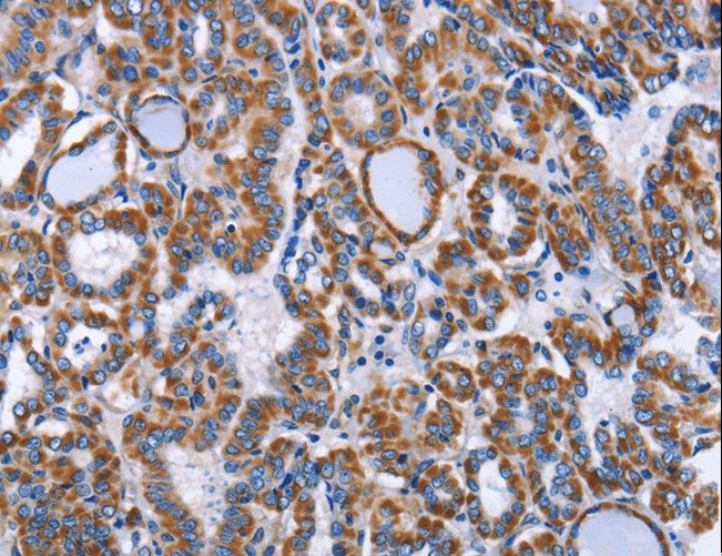 INTS10 Antibody - Immunohistochemistry of paraffin-embedded Human lung cancer using INTS10 Polyclonal Antibody at dilution of 1:50.