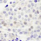 INTS4 Antibody - Detection of Human INT4 by Immunohistochemistry. Sample: FFPE section of human breast carcinoma. Antibody: Affinity purified rabbit anti-INT4 used at a dilution of 1:250.