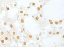 INTS6 Antibody - Detection of Human DDX26/DICE1 by Immunohistochemistry. Sample: FFPE section of human thyroid carcinoma. Antibody: Affinity purified rabbit anti-DDX46/DICE1 used at a dilution of 1:200 (1 ug/ml). Detection: DAB.
