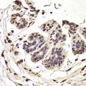 INTS6 Antibody - Immunohistochemistry of paraffin-embedded Human mammary cancer tissue.