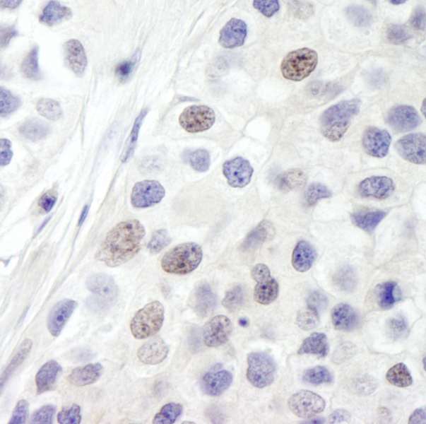 INTS8 Antibody - Detection of Human INT8 by Immunohistochemistry. Sample: FFPE section of human breast carcinoma Antibody: Affinity purified rabbit anti-INT8 used at a dilution of 1:250.