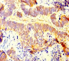 INTS9 Antibody - Immunohistochemistry of paraffin-embedded human ovarian cancer at dilution of 1:100