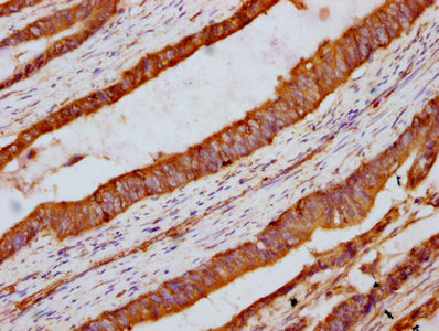 INTU Antibody - Immunohistochemistry Dilution at 1:300 and staining in paraffin-embedded human colon cancer performed on a Leica BondTM system. After dewaxing and hydration, antigen retrieval was mediated by high pressure in a citrate buffer (pH 6.0). Section was blocked with 10% normal Goat serum 30min at RT. Then primary antibody (1% BSA) was incubated at 4°C overnight. The primary is detected by a biotinylated Secondary antibody and visualized using an HRP conjugated SP system.