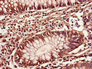 IOP1 / NARFL Antibody - Immunohistochemistry of paraffin-embedded human colon cancer using CIAO3 Antibody at dilution of 1:100