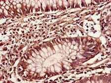 IOP1 / NARFL Antibody - Immunohistochemistry of paraffin-embedded human colon cancer using CIAO3 Antibody at dilution of 1:100