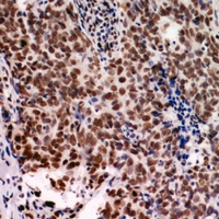 IOP1 / NARFL Antibody - Immunohistochemical analysis of NARFL staining in human breast cancer formalin fixed paraffin embedded tissue section. The section was pre-treated using heat mediated antigen retrieval with sodium citrate buffer (pH 6.0). The section was then incubated with the antibody at room temperature and detected using an HRP conjugated compact polymer system. DAB was used as the chromogen. The section was then counterstained with haematoxylin and mounted with DPX.