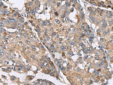 IP6K2 Antibody - Immunohistochemistry of paraffin-embedded Human liver cancer tissue  using IP6K2 Polyclonal Antibody at dilution of 1:220(×200)