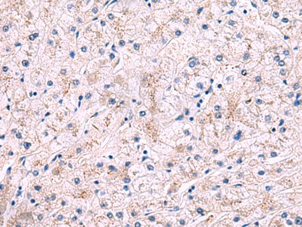 IP6K2 Antibody - Immunohistochemistry of paraffin-embedded Human liver cancer tissue  using IP6K2 Polyclonal Antibody at dilution of 1:50(×200)