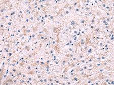 IP6K2 Antibody - Immunohistochemistry of paraffin-embedded Human liver cancer tissue  using IP6K2 Polyclonal Antibody at dilution of 1:50(×200)