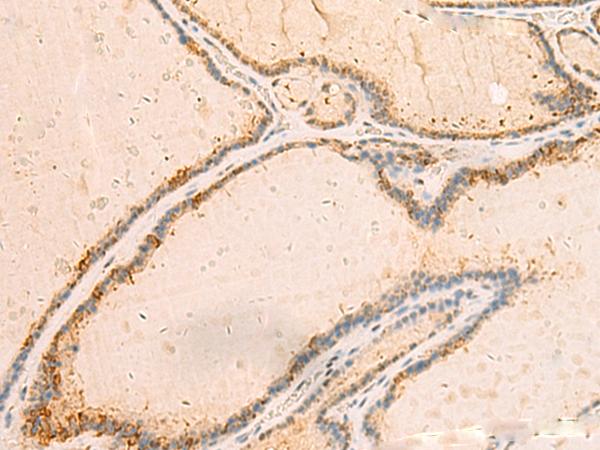 IP6K3 Antibody - Immunohistochemistry of paraffin-embedded Human thyroid cancer tissue  using IP6K3 Polyclonal Antibody at dilution of 1:50(×200)